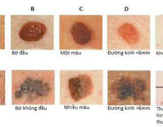 Cẩn trọng với những tổn thương da "kỳ kỳ" ở người lớn tuổi