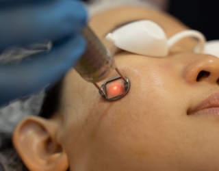 Cần lưu ý gì khi: Điều trị nám má bằng laser?