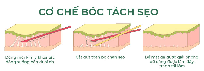 Bóc tách đáy sẹo