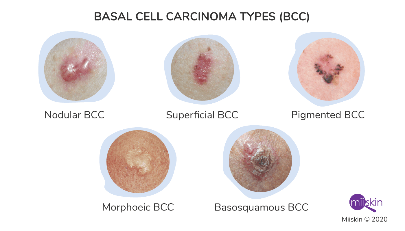 Một số thể lâm sàng của BCC