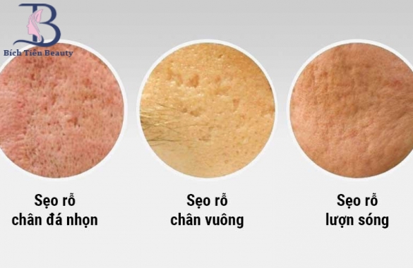 SẸO LÕM