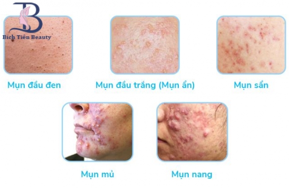 MỤN